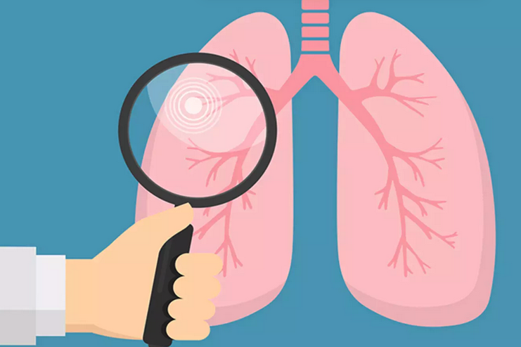 Lung Cancer Screening: Benefits of Scanning for Early Detection